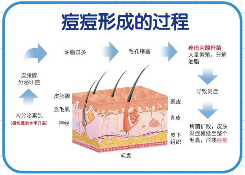 痘痘形成